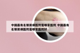 中国最有名银屑病医院是哪家医院 中国最有名银屑病医院是哪家医院好