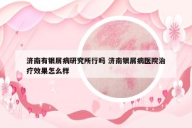 济南有银屑病研究所行吗 济南银屑病医院治疗效果怎么样