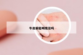 牛皮癣能喝槐豆吗