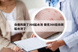白癜风做了308起水泡 做完308后白斑起水泡了