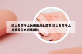 脸上和脖子上长癣是怎么回事 脸上和脖子上长癣是怎么回事图片