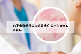 30岁会突然得头皮银屑病吗 三十岁会有白头发吗