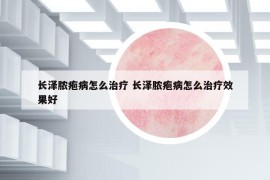 长泽脓疱病怎么治疗 长泽脓疱病怎么治疗效果好