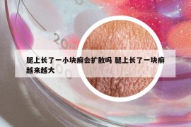 腿上长了一小块癣会扩散吗 腿上长了一块癣越来越大