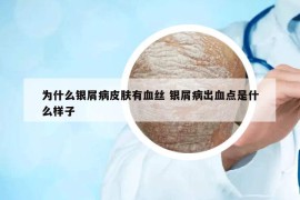 为什么银屑病皮肤有血丝 银屑病出血点是什么样子