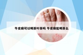 牛皮癣可以喝茶叶茶吗 牛皮癣能喝茶么