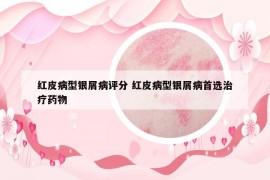 红皮病型银屑病评分 红皮病型银屑病首选治疗药物