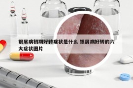银屑病初期好转症状是什么 银屑病好转的六大症状图片