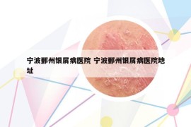 宁波鄞州银屑病医院 宁波鄞州银屑病医院地址