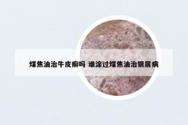 煤焦油治牛皮癣吗 谁涂过煤焦油治银屑病
