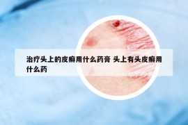 治疗头上的皮癣用什么药膏 头上有头皮癣用什么药