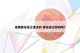 皮肤藓会自己变淡的 藓会自己好的吗?