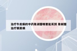 治疗牛皮癣的中药象淑醋哪里能买到 象椒醋治疗银屑病