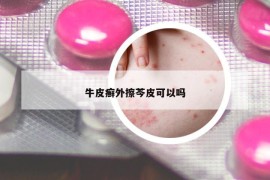 牛皮癣外擦芩皮可以吗