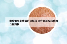 治疗银屑皮肤病的口服药 治疗银屑皮肤病的口服药物