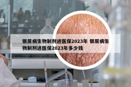 银屑病生物制剂进医保2023年 银屑病生物制剂进医保2023年多少钱
