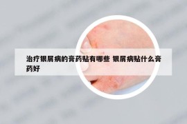 治疗银屑病的膏药贴有哪些 银屑病贴什么膏药好