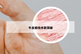 牛皮癣技术新突破