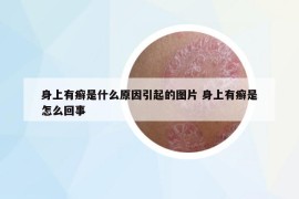 身上有癣是什么原因引起的图片 身上有癣是怎么回事