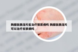 胸腺肽肠溶片能治疗银屑病吗 胸腺肽肠溶片可以治疗皮肤病吗