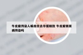 牛皮廨传染人嘛南京去华厦精致 牛皮廨银屑病传染吗