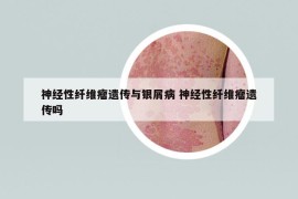 神经性纤维瘤遗传与银屑病 神经性纤维瘤遗传吗