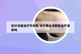 松针泡澡治疗牛皮癣 松针煮水泡脚能治疗湿疹吗