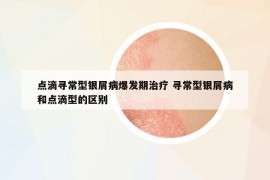 点滴寻常型银屑病爆发期治疗 寻常型银屑病和点滴型的区别