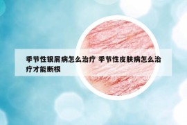季节性银屑病怎么治疗 季节性皮肤病怎么治疗才能断根