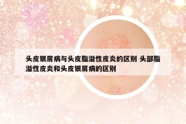 头皮银屑病与头皮脂溢性皮炎的区别 头部脂溢性皮炎和头皮银屑病的区别