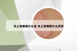 头上有癣用什么洗 头上有癣擦什么药膏