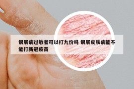 银屑病过敏者可以打九价吗 银屑皮肤病能不能打新冠疫苗