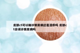 皮肤ct可以确诊银屑病还是湿疹吗 皮肤ct会误诊银屑病吗