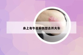 身上有牛皮癣我想去开大车