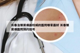 长春治银屑病最权威的医院哪家最好 长春银屑病医院预约挂号