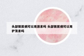 头部银屑病可以用激素吗 头部银屑病可以用护发素吗