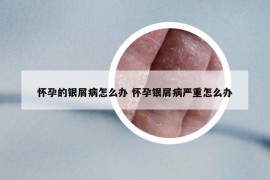 怀孕的银屑病怎么办 怀孕银屑病严重怎么办