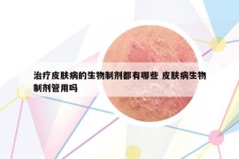 治疗皮肤病的生物制剂都有哪些 皮肤病生物制剂管用吗