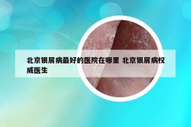 北京银屑病最好的医院在哪里 北京银屑病权威医生