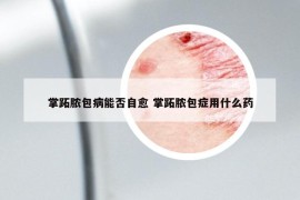 掌跖脓包病能否自愈 掌跖脓包症用什么药