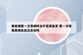 银屑病第一次发病咋治不容易复发 第一次得银屑病自愈还会犯吗