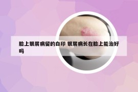 脸上银屑病留的白印 银屑病长在脸上能治好吗
