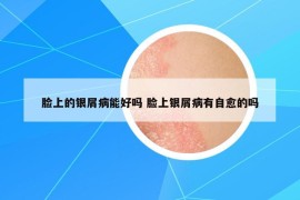 脸上的银屑病能好吗 脸上银屑病有自愈的吗