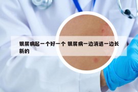 银屑病起一个好一个 银屑病一边消退一边长新的