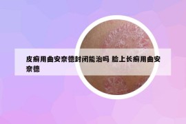 皮癣用曲安奈德封闭能治吗 脸上长癣用曲安奈德