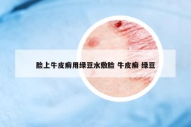脸上牛皮癣用绿豆水敷脸 牛皮癣 绿豆