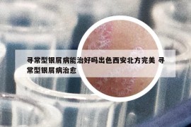 寻常型银屑病能治好吗出色西安北方完美 寻常型银屑病治愈