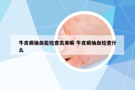 牛皮癣抽血能检查出来嘛 牛皮癣抽血检查什么