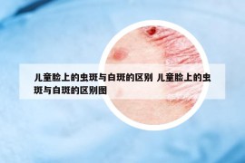 儿童脸上的虫斑与白斑的区别 儿童脸上的虫斑与白斑的区别图