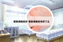 银屑病爆皮好 银屑病爆皮快好了么